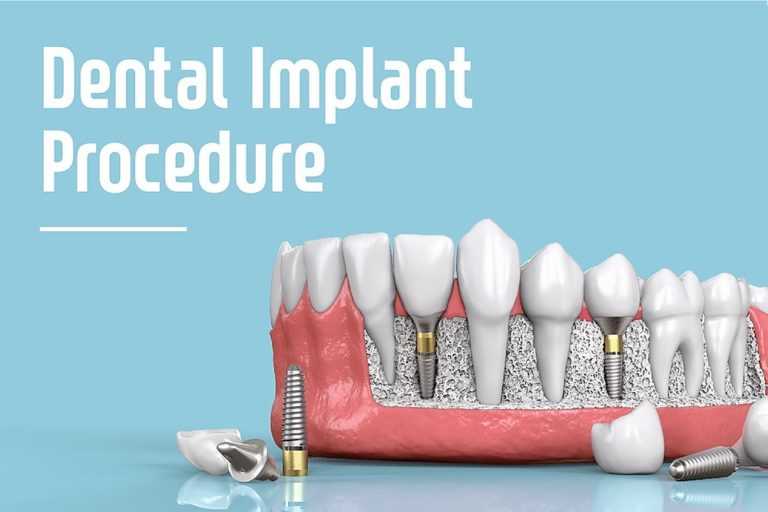 Dental implant procedure reference image for treatment planning