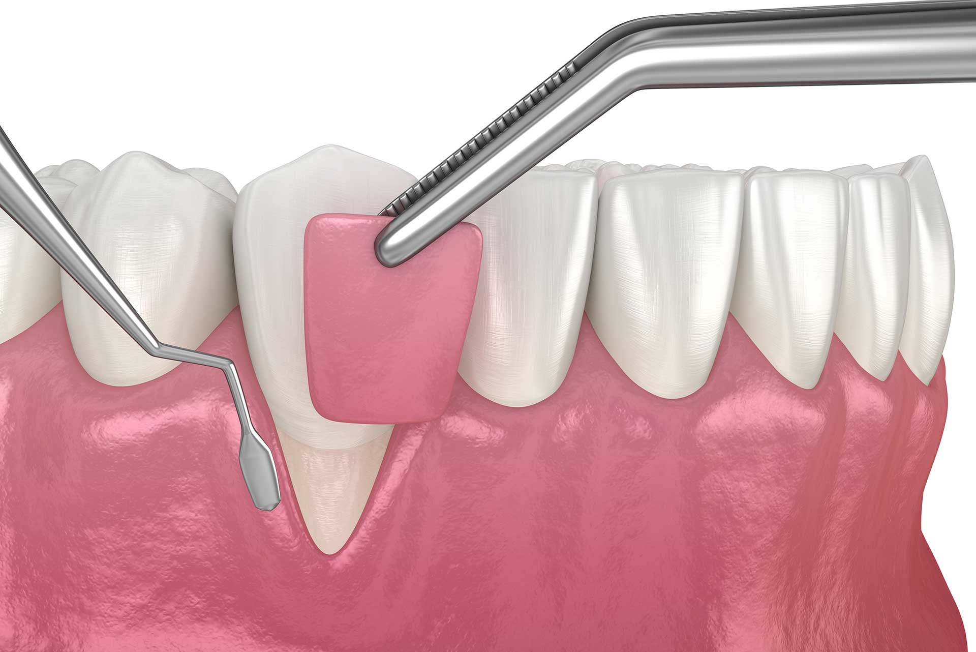 Home Gum & Bone Surgery