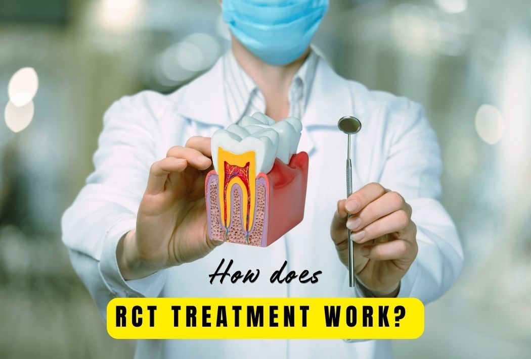 Root canal treatment process illustration