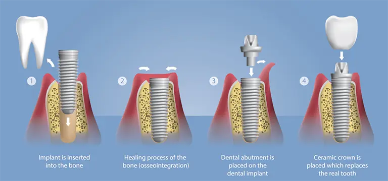 Dental implant illustration showing a replacement tooth and implant